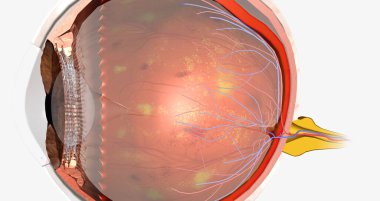 Diabetic retinopathy is a complication of diabetes that affects the eyes. 3D rendering