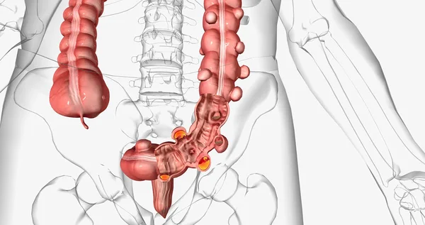 Diverticulosis occurs when small, bulging pouches develop in your digestive tract. 3D rendering