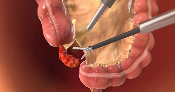 Locating and Grasping the Appendix 3D rendering