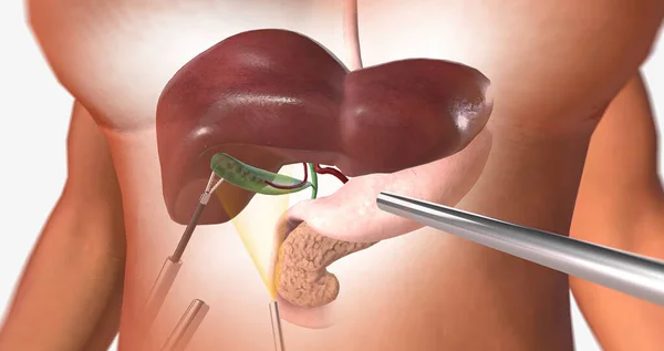 Locating and Retracting the Gallbladder 3D rendering