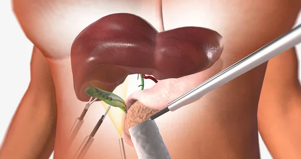 The Removal of the Gallbladder 3D rendering