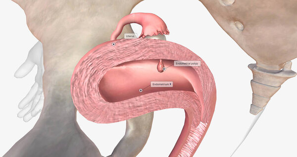 Endometrial polyps are abnormal growths of the inner lining of the uterus, known as the endometrium. 3D rendering