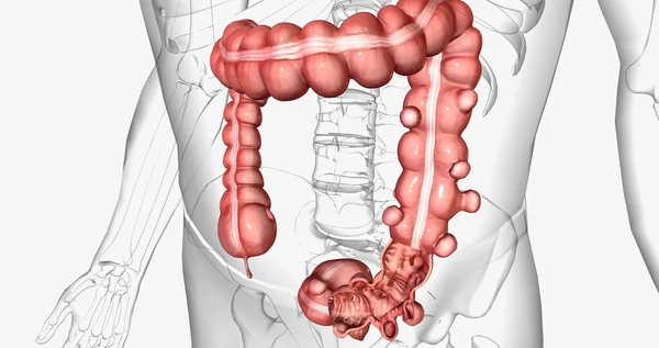 stock image Diverticulosis is a condition characterized by the formation of diverticula in the walls of the intestines. 3D rendering