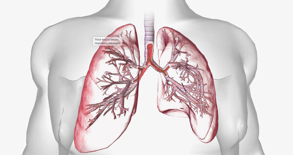 Cystic fibrosis is a genetically inherited disease that affects secretory cells throughout the body. 3D rendering