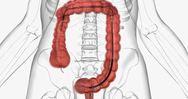 Colonoscopy is an invasive procedure used to look inside the large intestines. 3D rendering