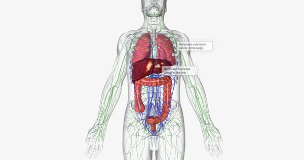 Colorectal Cancer Crc Common Colon Rectal Cancer Affects Many Patients — Stockfoto