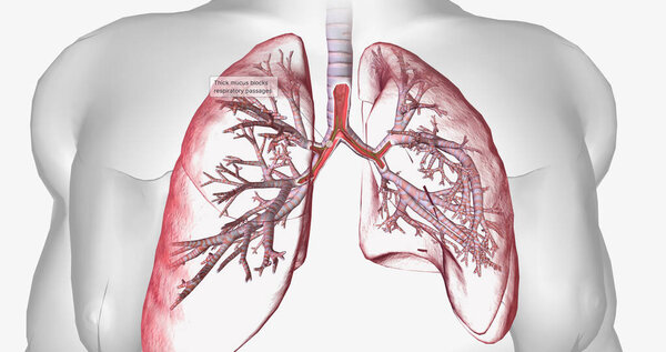 Cystic fibrosis is a genetically inherited disease that affects secretory cells throughout the body. 3D rendering