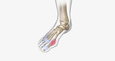 Gout is a common type of inflammatory arthritis, a disease in which the immune system attacks bones and joints.3D rendering