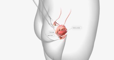 Gonorrhea is a sexually transmitted infection caused by the bacterium Neisseria gonorrhoeae 3D rendering