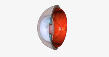 Interstitial keratitis is inflammation of the tissue of the cornea, the clear window on the front of the eye.3D rendering