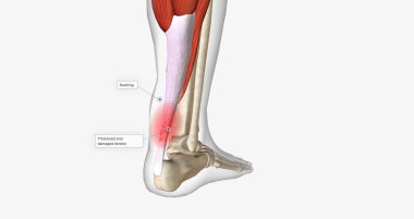 An ankle strain occurs when the muscles or tendons around the ankle are stretched too far. 3D rendering
