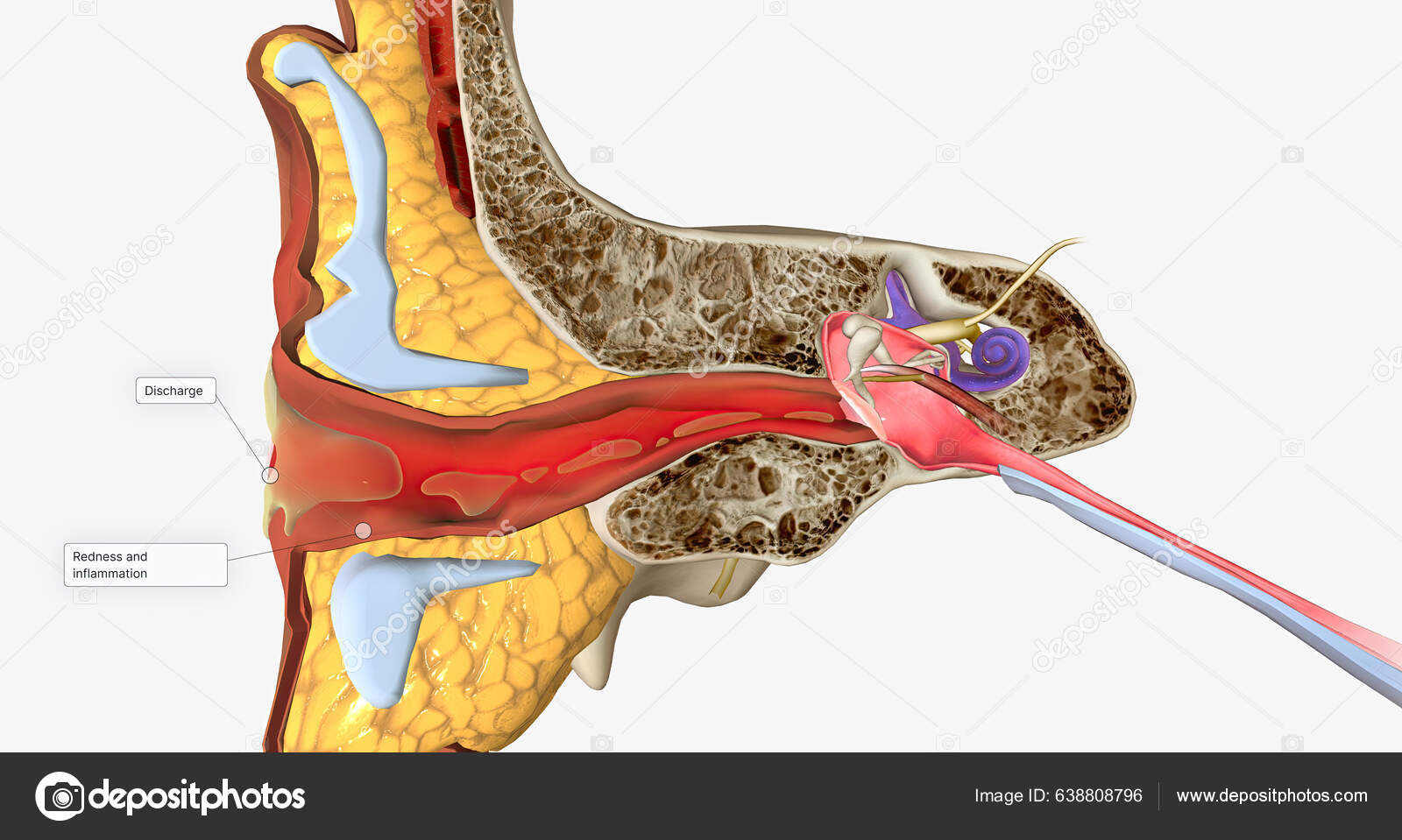 Outer Ear Infection Also Called Otitis Externa Rendering Stock