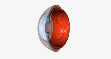 Interstitial keratitis is inflammation of the tissue of the cornea, the clear window on the front of the eye.3D rendering