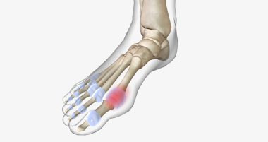 Gout is a common type of inflammatory arthritis, a disease in which the immune system attacks bones and joints.3D rendering