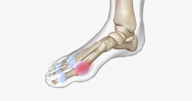 Gout is a common type of inflammatory arthritis, a disease in which the immune system attacks bones and joints.3D rendering