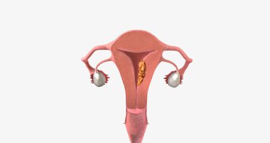 Stage II endometrial cancer is characterized by tumor spread to the uterine cervix. 3D rendering