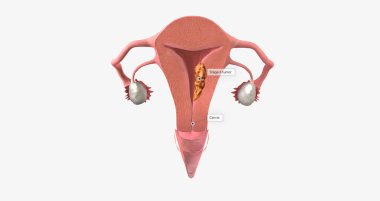 Stage II endometrial cancer is characterized by tumor spread to the uterine cervix. 3D rendering
