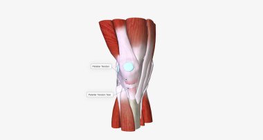 When a tendon is weakened by age or overuse, trauma can cause it to rupture.3D rendering