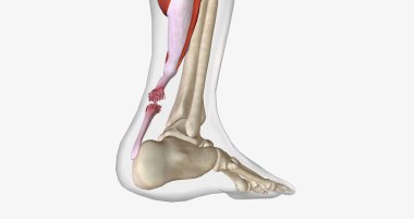 Flexion and Extension with Torn Achilles Tendon 3D rendering