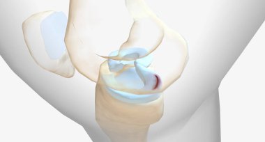 A meniscus tear is one of the most common knee injuries.3D rendering