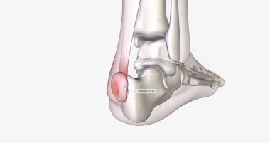 Haglunds deformity is bony enlargement at the back of the heel, leading to painful bursitis.3D rendering