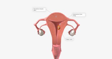 Stage I endometrial cancer begins in the endometrium and spreads to the myometrium of the uterus 3D rendering