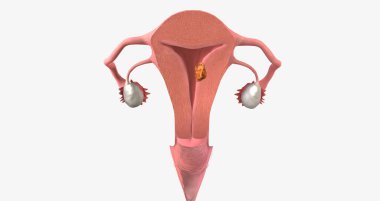 Stage I endometrial cancer begins in the endometrium and spreads to the myometrium of the uterus 3D rendering