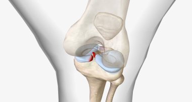 Meniscal root tears are less common than meniscal body tears and frequently go undetected.3D rendering