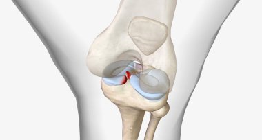 Meniscal root tears are less common than meniscal body tears and frequently go undetected.3D rendering clipart