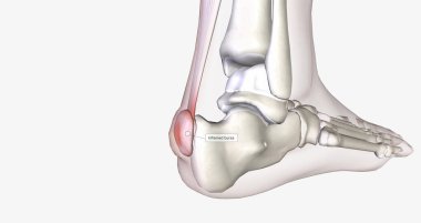 Haglunds deformity is bony enlargement at the back of the heel, leading to painful bursitis.3D rendering