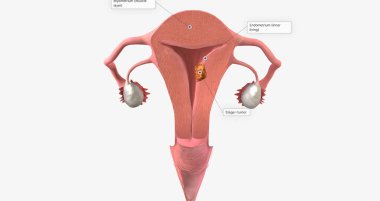 Stage I endometrial cancer begins in the endometrium and spreads to the myometrium of the uterus 3D rendering