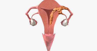 During stage III endometrial cancer, the tumor spreads outside of the uterus. 3D rendering
