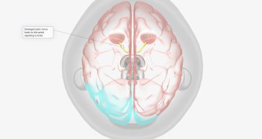 Damaged optic nerve leads to disrupted signaling to brain 3D rendering