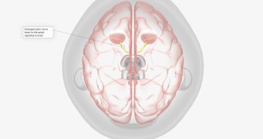 Damaged optic nerve leads to disrupted signaling to brain 3D rendering