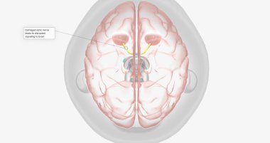 Damaged optic nerve leads to disrupted signaling to brain 3D rendering