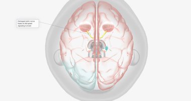 Damaged optic nerve leads to disrupted signaling to brain 3D rendering