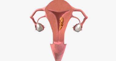 Stage II endometrial cancer is characterized by tumor spread to the uterine cervix. 3D rendering