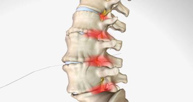 Dejeneratif disk hastalığı omurgalar arası disklerin yavaş yavaş bozulmasıyla karakterize edilir. 3B görüntüleme