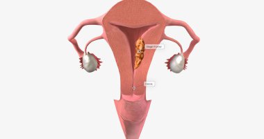 Stage II endometrial cancer is characterized by tumor spread to the uterine cervix. 3D rendering