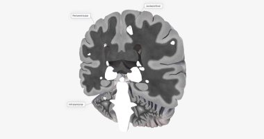 The Brain with lesions MRI 3D rendering