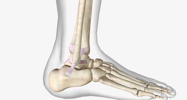 Lateral Ankle Sprain Torn Anterior Talofibular Ligament 3D rendering