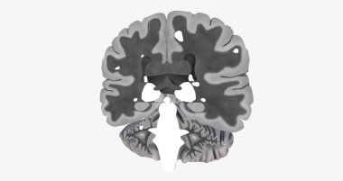 The Brain with lesions MRI 3D rendering