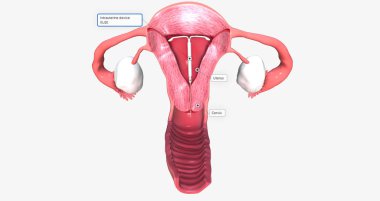 intra uterine device inside fantom uterus 3D rendering