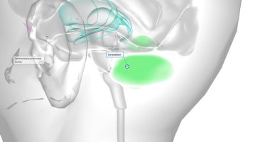 This reduced volume of the prefrontal cortex has been shown to lead to decreased activity levels in other parts of the brain. 3D rendering