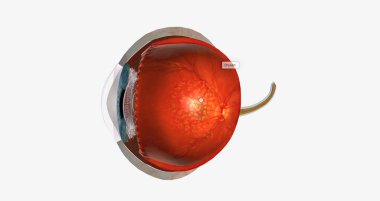 Dry macular degeneration is a type of age-related vision impairment that results in blurred or lost central vision.3D rendering