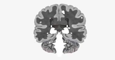 The Brain with lesions MRI 3D rendering