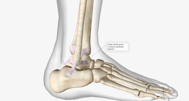Lateral Ankle Sprain Torn Anterior Talofibular Ligament 3D rendering