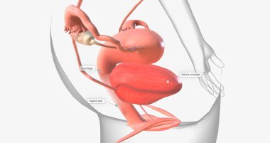 Gonorrhea is a sexually transmitted infection caused by the bacterium Neisseria gonorrhoeae 3D rendering