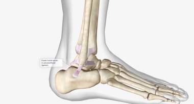 Grade II ankle sprain 3D rendering