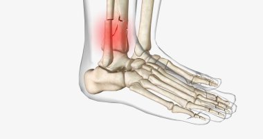 Distal tibia fractures affect the ankle joint and can often involve a fracture of the fibula. 3D rendering
